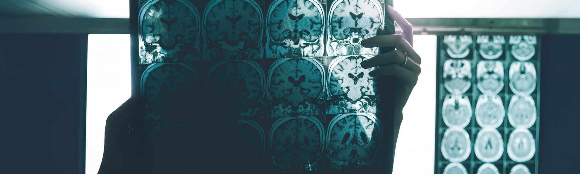 Alzheimers disease on MRI film